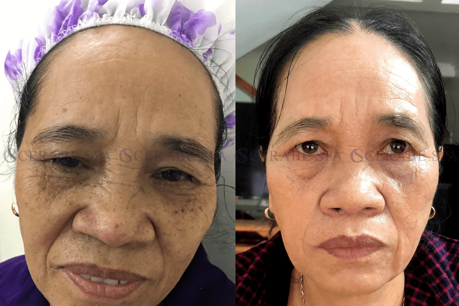 Khách hàng Nguyễn Thị Thế 65 tuổi liệu trình điều trị nám, đồi mồi