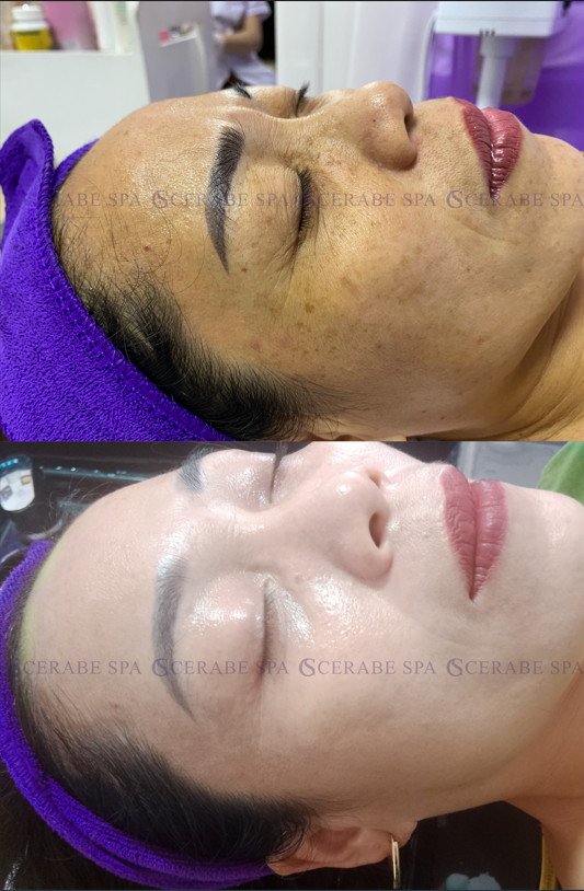 Hình ảnh trước và sau của cô khách hàng điều trị nám tại cơ sở Cerabe Spa số 29
